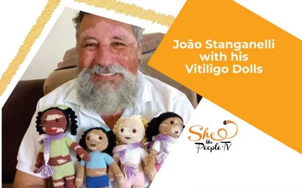 Vitiligo dolls